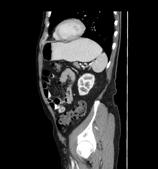 Appendicitis with localized perforation and abscess formation (Radiopaedia 49035-54130 C 49).jpg