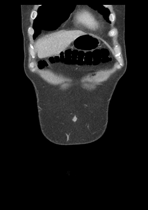Appendicitis with thickening of the terminal ileum (Radiopaedia 42432-45550 B 7).png