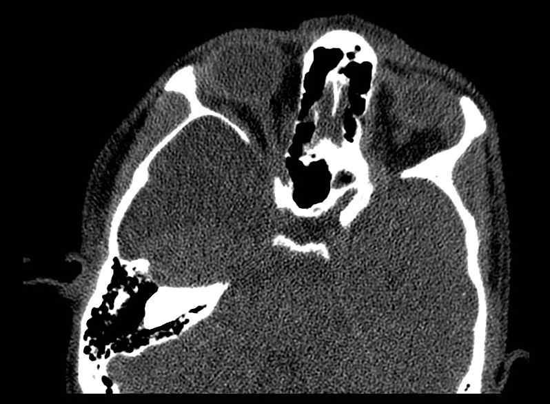 Arachnoid cyst- extremely large (Radiopaedia 68741-78450 Axial bone window 27).jpg