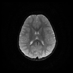 Arachnoid cyst - middle cranial fossa (Radiopaedia 86780-102938 Axial DWI 41).jpg