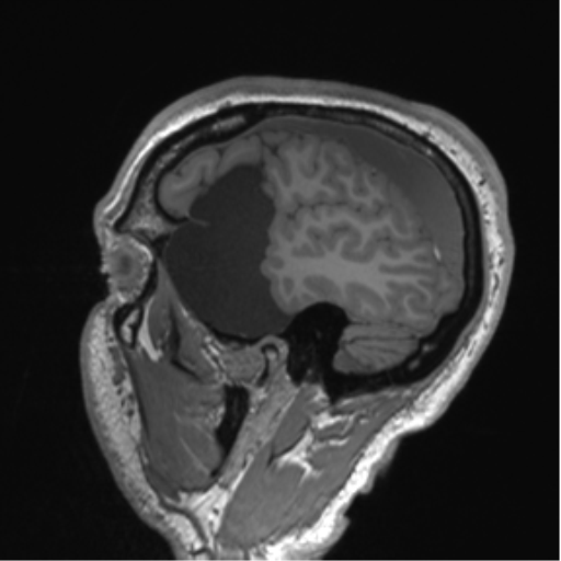 Arachnoid cyst with subdural hematoma (Radiopaedia 85892-101743 Sagittal T1 22).png