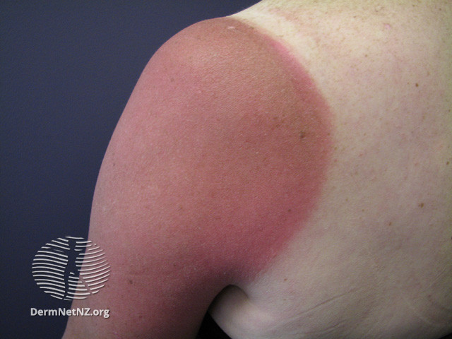 File:Around 4-7 days after exposure skin may start to peel and flake off. (DermNet NZ reactions-sunburn7).jpg