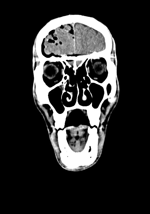 Arrow injury to the brain (Radiopaedia 72101-82607 Coronal non-contrast 21).jpg