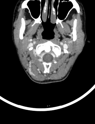 Arteriovenous malformation of the neck (Radiopaedia 53935-60062 B 7).jpg