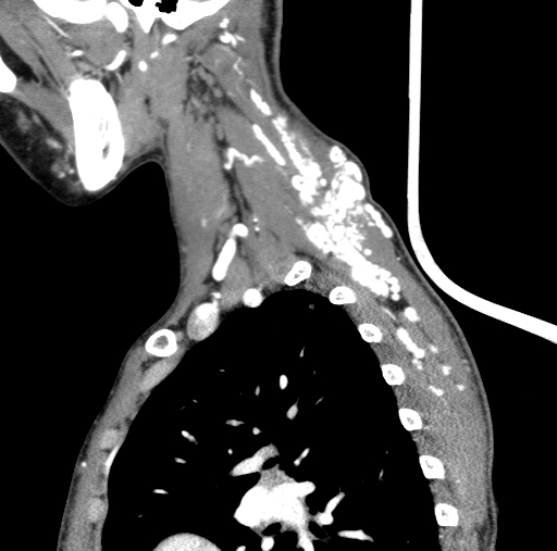File:Arteriovenous malformation of the neck (Radiopaedia 53935-60062 C 27).jpg