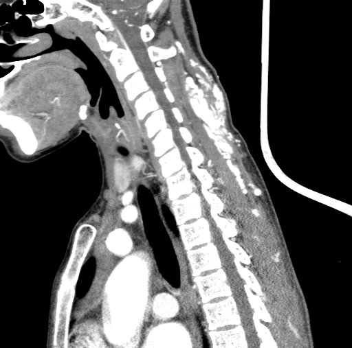Arteriovenous malformation of the neck (Radiopaedia 53935-60062 C 60).jpg