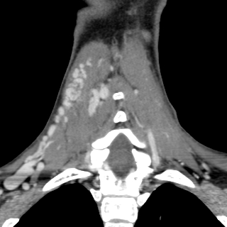 Arteriovenous malformation of the neck (Radiopaedia 53935-60062 D 35).jpg