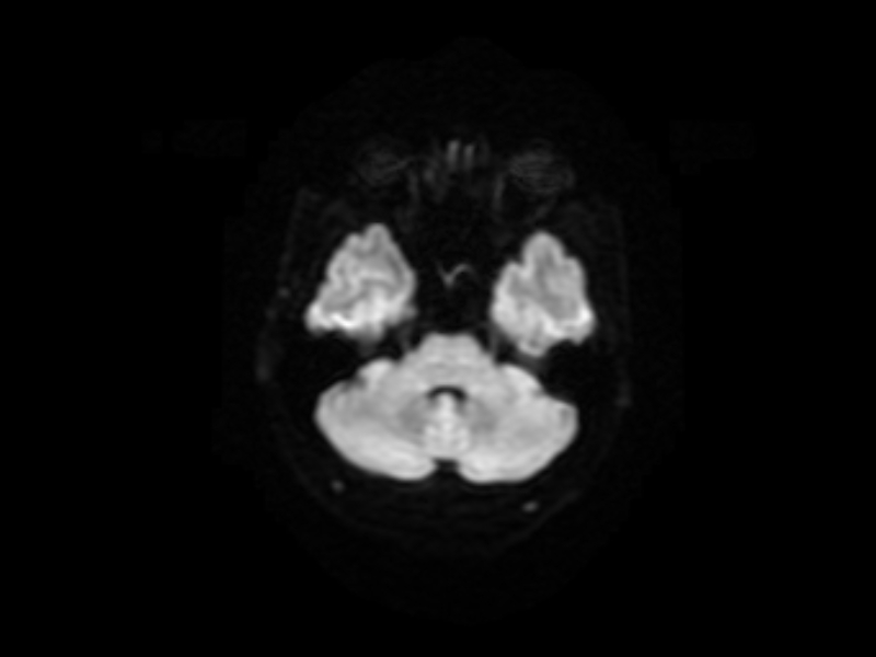 File:Artery of Percheron infarct (Radiopaedia 36897-38526 Axial DWI 4).jpg