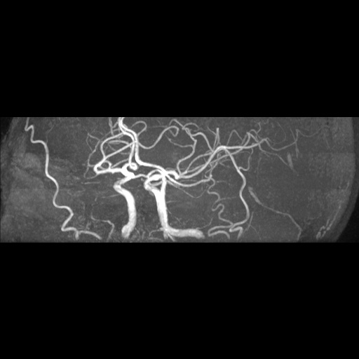 Artery of Percheron infarction (Radiopaedia 27975-28230 3D TOF 6).jpg