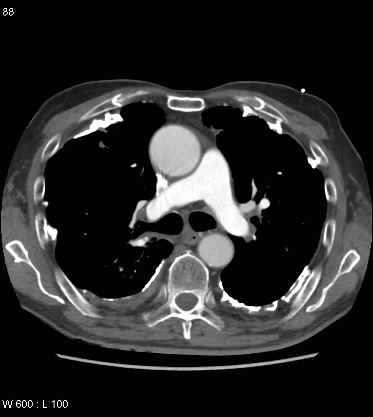 Asbestos related lung and pleural disease (Radiopaedia 14377-14301 D 24).jpg