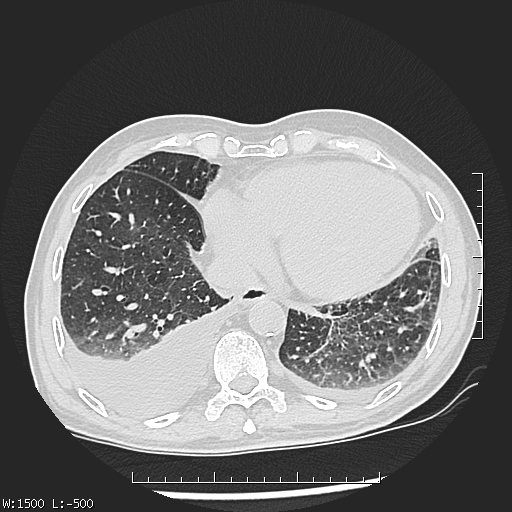Aspergilloma (Radiopaedia 75184-86270 Axial lung window 41).jpg