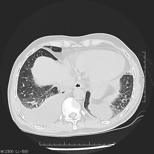 File:Aspergilloma (Radiopaedia 75184-86270 Axial lung window 44).jpg