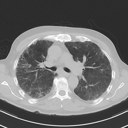 Aspergilloma on background pulmonary fibrosis (Radiopaedia 60942-68757 A 24).jpg
