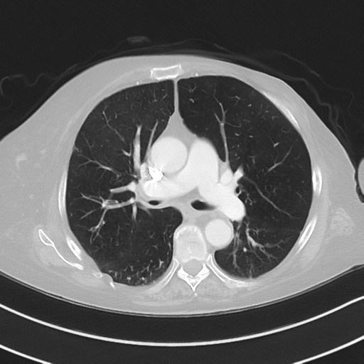 Aspiration bronchiolitis (Radiopaedia 53464-59463 Axial lung window 25).png