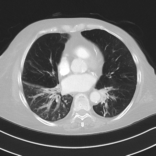 Aspiration bronchiolitis (Radiopaedia 53464-59463 Axial lung window 34).png