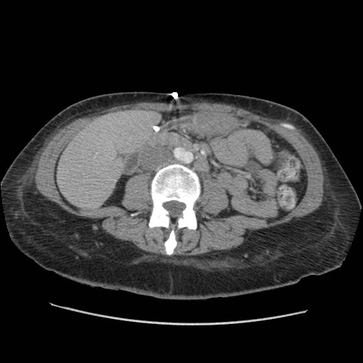 File:Aspiration pneumonia secondary to laparoscopic banding (Radiopaedia 18345-18183 A 72).jpg