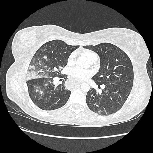 Aspiration pneumonia secondary to laparoscopic banding (Radiopaedia 18345-18183 lung window 57).jpg