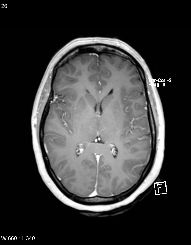 Astroblastoma (Radiopaedia 39792-42218 Axial T1 C+ 25).jpg