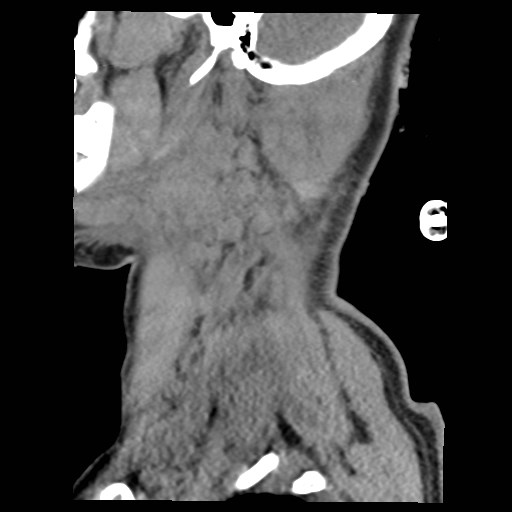 File:Atlanto-occipital dislocation (Radiopaedia 44648-48412 A 29).jpg
