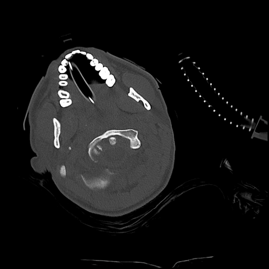 File:Atlanto-occipital dissociation (Traynelis type 1), C2 teardrop fracture, C6-7 facet joint dislocation (Radiopaedia 87655-104061 Axial bone window 18).jpg