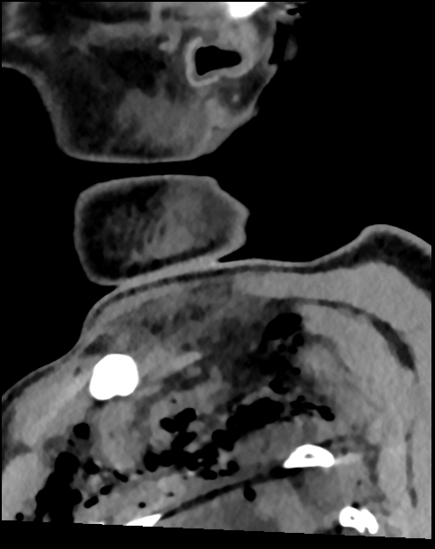 Atlanto-occipital dissociation - Traynelis type 1 (Radiopaedia 87570-103948 D 10).jpg