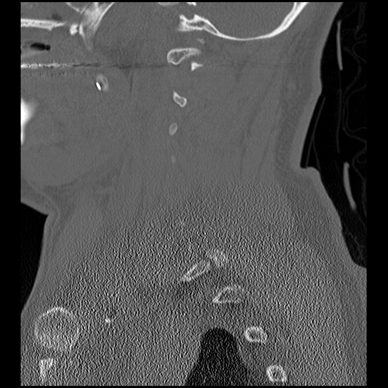 Atlanto-occipital dissociation injury (Radiopaedia 29274-29698 Sagittal bone window 15).png