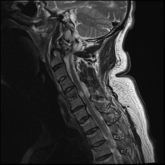 File:Atlas (type 3b subtype 1) and axis (Anderson and D'Alonzo type 3, Roy-Camille type 2) fractures (Radiopaedia 88043-104610 Sagittal T2 8).jpg