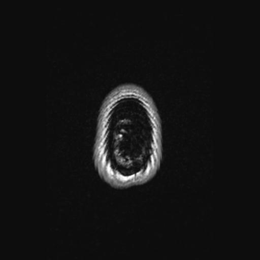 Atretic encephalocoele with inferior vermis hypoplasia (Radiopaedia 30443-31108 Axial 150).jpg