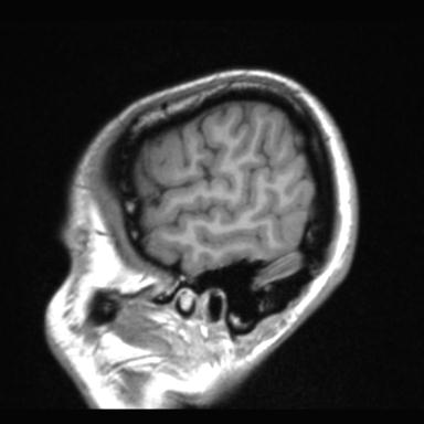 Atretic encephalocoele with inferior vermis hypoplasia (Radiopaedia 30443-31108 Sagittal T1 119).jpg