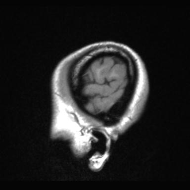 Atretic encephalocoele with inferior vermis hypoplasia (Radiopaedia 30443-31108 Sagittal T1 4).jpg
