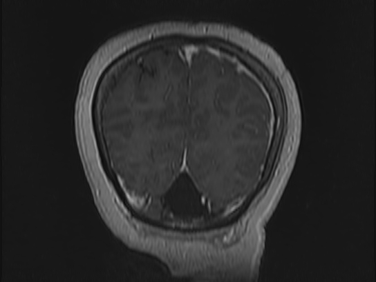 File:Atypical meningioma (Radiopaedia 62985-71406 Coronal T1 C+ 112).jpg