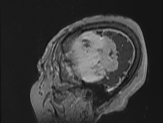 Atypical meningioma (Radiopaedia 62985-71406 Sagittal T1 C+ 89).jpg