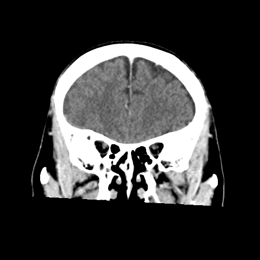 Atypical meningioma with skull invasion (Radiopaedia 34357-35649 Coronal C+ delayed 18).png