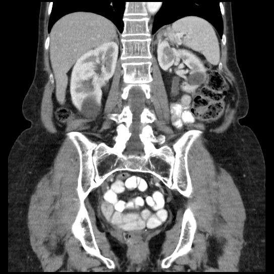 File:Atypical renal cyst (Radiopaedia 17536-17251 C 12).jpg