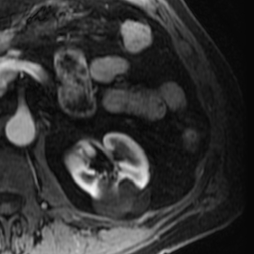 File:Atypical renal cyst on MRI (Radiopaedia 17349-17046 C 13).jpg