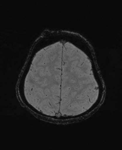 Autoimmune limbic encephalitis (Radiopaedia 30363-31005 SWI - magnitude 65).jpg
