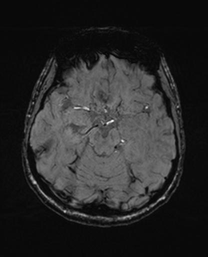 Autoimmune limbic encephalitis (Radiopaedia 30363-31005 SWI 29).jpg
