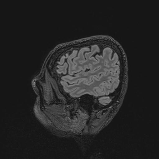 Autoimmune limbic encephalitis (Radiopaedia 30363-31005 Sagittal FLAIR 129).jpg