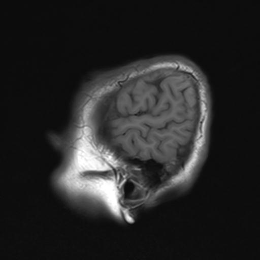 File:Autoimmune limbic encephalitis (Radiopaedia 30363-31005 Sagittal T1 24).jpg