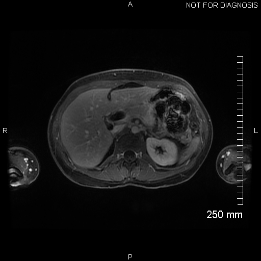 File:Autoimmune pancreatitis (Radiopaedia 88443-105101 A 57).jpg