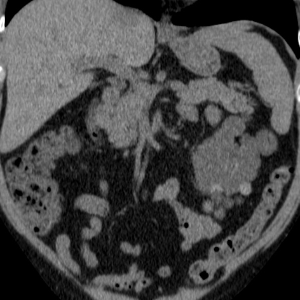 File:Autosomal dominant polycystic kidney disease (Radiopaedia 36539-38101 Coronal non-contrast 11).jpg
