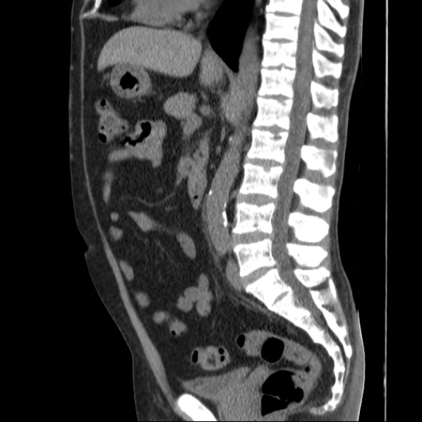 Autosomal dominant polycystic kidney disease (Radiopaedia 36539-38101 D 44).jpg