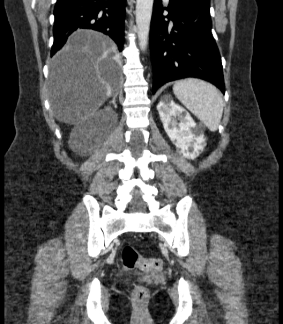 Autosomal dominant polycystic kidney disease (Radiopaedia 57124-64017 B 56).jpg