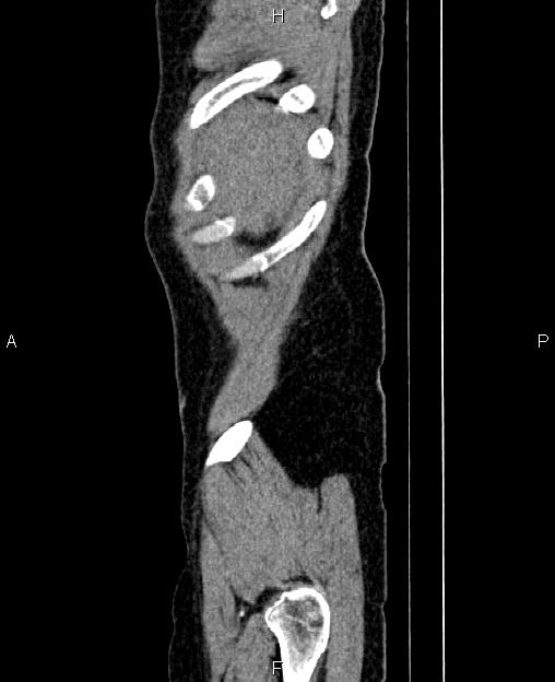 Autosomal dominant polycystic kidney disease (Radiopaedia 87830-104287 C 1).jpg