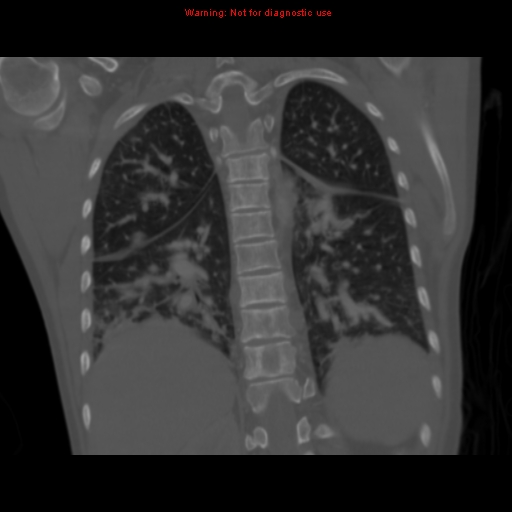 File:Avascular necrosis in sickle cell disease (Radiopaedia 17448-17152 Coronal bone window 91).jpg