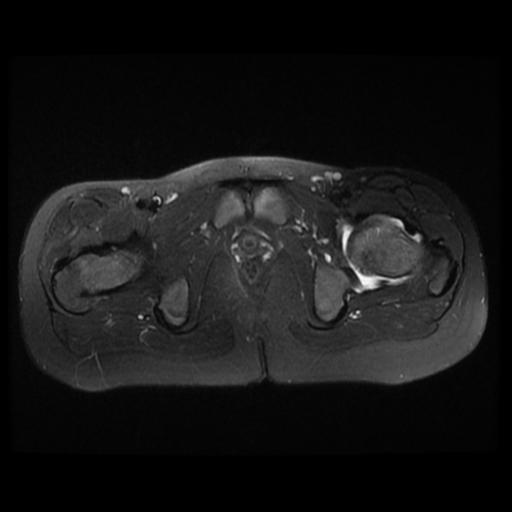 File:Avascular necrosis of the hip (Radiopaedia 29563-30067 Axial T2 fat sat 12).jpg