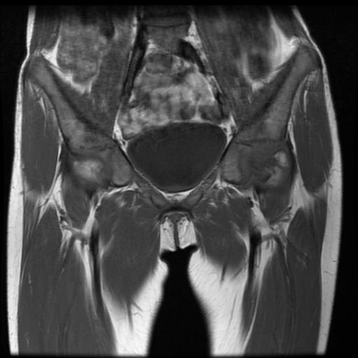 File:Avascular necrosis of the hip (Radiopaedia 29563-30067 Coronal T1 4).jpg