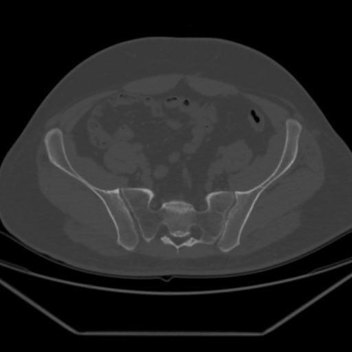 File:Avascular necrosis of the hip (Radiopaedia 61503-69467 Axial bone window 13).jpg