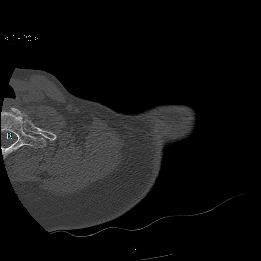Avascular necrosis of the shoulder - Cruess stage I (Radiopaedia 77674-89887 Axial bone window 5).jpg