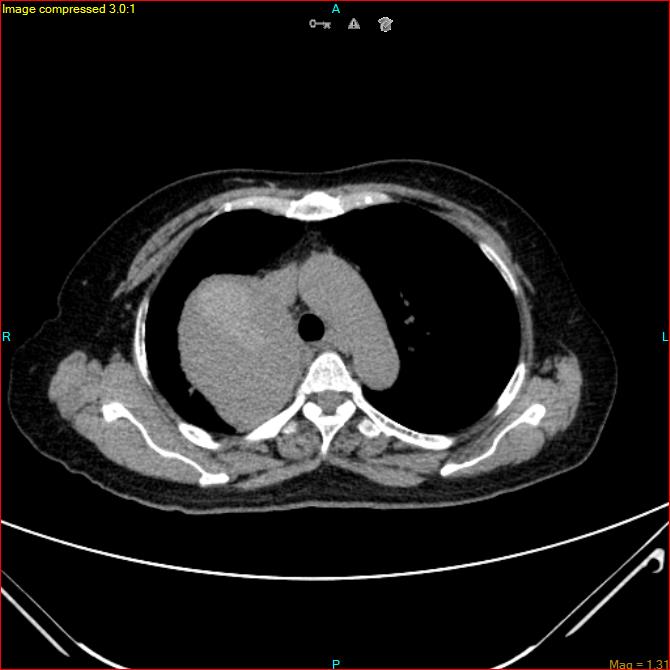 Azygos vein aneurysm (Radiopaedia 77824-90130 A 20).jpg